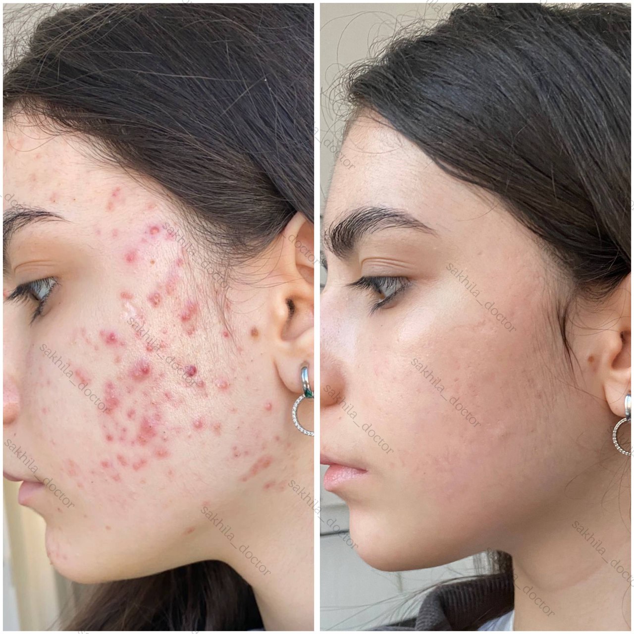 Результат лечения 7