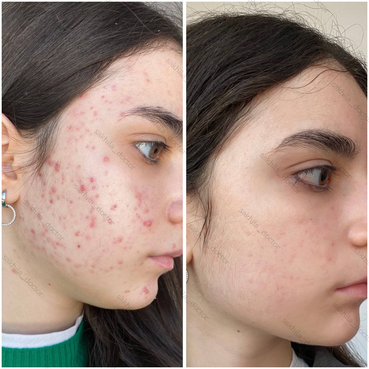 Результат лечения 8